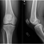 Fig. 1 Anteroposterior (left) and lateral (right) radiographs of the right knee from the patient’s second visit with the sports medicine department demonstrating a lytic lesion in the superomedial aspect of the distal part of the femur with a surrounding border and associated effusion.
