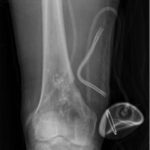 Fig. 10 Anteroposterior radiograph of the right distal part of the femur postoperatively demonstrating antibiotic beads within the femoral metaphysis and surgical drain in the distal thigh.
