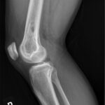 Fig. 11 Lateral radiograph of the right knee at 4 months postoperatively showing increased bone formation in the distal part of the femur without evidence of periosteal reaction.
