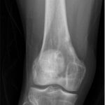 Fig. 12 Anteroposterior radiograph of the right knee at 4 months postoperatively showing increased bone formation in the distal part of the femur and healing of the lesion without evidence of periosteal reaction.
