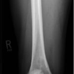 Fig. 2 Anteroposterior radiograph of the distal part of the femur demonstrating a lytic lesion medially.
