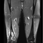 Fig. 3 Coronal T1-weighted, fat-saturated, postgadolinium MRI scan from an outside hospital demonstrating a geographic, lobulated mass in the distal right femoral metaphysis with surrounding edema.
