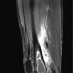 Fig. 4 Sagittal T1-weighted, fat-saturated, postgadolinium MRI scan from an outside hospital demonstrating a geographic, lobulated mass in the distal right femoral metaphysis with surrounding edema. There is a separate fluid collection posterior to the distal part of the femur.
 
 
