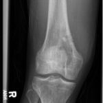 Fig. 6 Anteroposterior radiograph of the right knee at 1 month postoperatively demonstrating a healing cavitary lesion of the medial femoral condyle without progression of the lesion.
