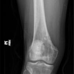 Fig. 7 Anteroposterior radiograph of the right knee at 3 months postoperatively demonstrating continued healing of the cavitary lesion of the medial femoral condyle without progression.
