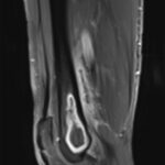 Fig. 8 Sagittal T1-weighted, fat-saturated, postgadolinium, 1.5-T MRI scan demonstrating a lesion within the femoral metaphysis. There is an additional mass posterior to the femur.
