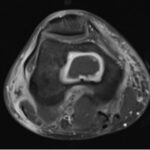 Fig. 9 Axial T1-weighted, fat-saturated, postgadolinium, 1.5-T MRI scan demonstrating a lesion within the femoral metaphysis. There is an additional mass posterolateral to the femur.
