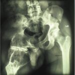 Fig. 1-A Preoperative anteroposterior radiograph of the hip showing the extruding acetabulum with a huge, deformed femoral head.
