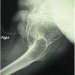 Fig. 1-B Preoperative lateral radiograph of the hip showing the extruding acetabulum with a huge, deformed femoral head.
