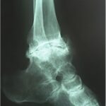 Fig. 1-C Lateral radiograph of the ankle showing severe degenerative joint disease, the deformed talus, and a large exostosis.
