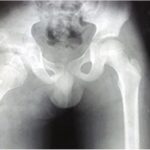 Fig. 2-A Radiograph of the hip made when the patient was 9 years of age. The beginning of an osteocartilaginous mass in the acetabular cavity is evident.
