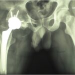 Fig. 3-A Postoperative anteroposterior radiograph of the hip.
