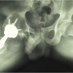 Fig. 3-B Postoperative frog-leg lateral radiograph of the hip.

