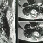 Fig. 2 T2-weighted MRI scans of the lumbar spine. Fig. 2-A Sagittal view: the lesion extends from the subcutaneous tissue of the lumbar spine to the transversospinalis muscle group. Figs. 2-B and 2-C Consecutive axial views: the lesion (arrows) penetrates the posterior layer of the thoracolumbar fascia.
