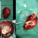 Fig. 3 Photographs of the lesion. Fig. 3-A The measurement of the lesion. Fig. 3-B The lesion was opened, revealing smaller cysts. Fig. 3-C The cyst was removed intact.
