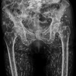 Fig. 1 Anteroposterior radiograph of the pelvis demonstrating a left femoral neck fracture and multiple soft-tissue calcified lesions.
