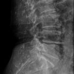 Fig. 2 Lateral radiograph of the lumbar and sacral spine demonstrating chronic osteoporotic vertebral fractures and countless calcified lesions.

