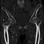 Fig. 3 CT scan of the pelvis confirming a left femoral neck fracture and evidencing a starry-sky appearance.
