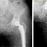 Fig. 4 Postoperative radiographs of the left hip with cemented components after a total hip arthroplasty: (left) hip and (right) femoral neck.
