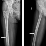 Fig. 1 Preoperative radiographs of the patient showing a lesion (white arrows) in the femoral diaphysis: (left) anteroposterior view and (right) lateral view.
