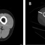 Fig. 2 CT images of the patient. Fig. 2-A The intramedullary lesion with matrix calcification (white arrow). Fig. 2-B Endosteal scalloping (white arrow).

