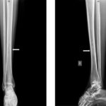 Fig. 4 Preoperative radiographs of the patient showing an ill-defined lesion (white arrows) in the right tibial diaphysis: (left) anteroposterior view, and (right) lateral view.
