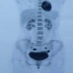 Fig. 5 PET image of the patient showing a fluorodeoxyglucose avid lesion in the right femur with a standardized uptake value of 8.6.
