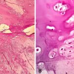 Fig. 6 Microscopic images of the tibial lesion. Fig. 6-A Lobules of the hyaline cartilage, ×100. Fig. 6-B Chondrocytes in lacunae, ×400.
