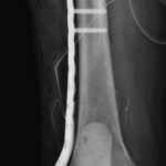 Fig. 3-A Anteroposterior radiograph of the right knee that underwent surgical fixation: open reduction and internal fixation of the right distal femoral supracondylar fracture with lateral femoral locking plate and cement.
