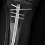 Fig. 3-B Anteroposterior radiograph of the right tibia that underwent surgical fixation: open reduction and internal fixation of the right tibial pathologic shaft fracture with an intramedullary rod and cement fixation.
