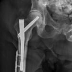 Fig. 3-C Anteroposterior radiograph of the right proximal part of the femur that underwent surgical fixation: prophylactic fixation of the right proximal part of the femur using a short intramedullary rod.
