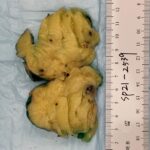 Fig. 4 Gross photograph of the soft-tissue lesion excised from the right vastus lateralis tissue. The tan-yellow specimen weighed 49 g and measured 7 × 5 × 2.2 cm, with circumscribed hemorrhagic nodules ranging from 0.3 to 0.7 cm.
