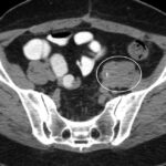 A 49-Year-Old Woman with Chronic Abdominal Pain