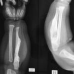 Fig. 2 Initial anteroposterior (left) and lateral (right) radiographs of the forearm showing areas of sclerosis and a lucent area with irregular margins and a soft-tissue shadow over the dorsal and medial ulnar border.
