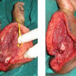 Fig. 7 Intraoperative photographs after the resection showing (left) the bone gap and (right) the one-bone forearm with an intramedullary nail inside.
