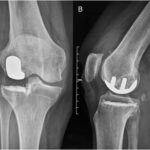 A 77-Year-Old Woman with Osteoarthritis and Diabetes