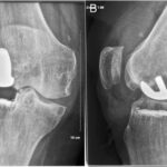 Fig. 2 Weight-bearing radiographs after the locking event: anteroposterior view (Fig. 2-A) and sagittal view (Fig. 2-B).
