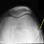 Fig. 1-A Radiograph of the left knee: sunrise view showing the nodule next to the lateral femoral epicondyle (arrow).
