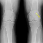 Fig. 1-B Radiograph of both knees: standing anteroposterior view showing the nodule next to the lateral femoral epicondyle in the left knee (yellow arrow).
