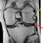Fig. 2-A Coronal proton-density-weighted MRI scan of the left knee showing the nodule overlaying the popliteus notch (yellow arrow) with marked thinning of the popliteus tendon (red arrow).
