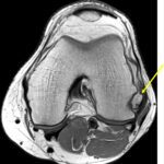 Fig. 2-B Axial proton-density-weighted MRI scan of the left knee showing the nodule overlaying the popliteus notch (yellow arrow).
