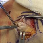 Fig 3-B Intraoperative photograph showing the direct examination of the nodule.
