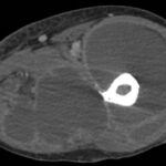 Fig. 1 Axial CT scan showing a large, rim-enhancing fluid collection around the left hip joint
