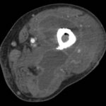 Fig. 2 Repeat axial CT scan of the left leg
