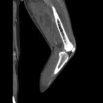 Fig. 3 Coronal CT scan showing abnormal intraosseous findings throughout the left femur.
