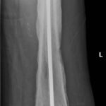 Fig. 5 Anterior-posterior radiograph showing an antibiotic rod in place.
