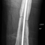 Fig. 6 Anterior-posterior radiograph showing a left midshaft femoral fracture with the intact antibiotic rod in place.
