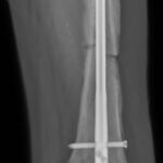 Fig. 7 Anterior-posterior radiograph showing a left midshaft femoral fracture with a standard femoral nail in place.
