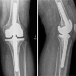 Fig. 1 Radiographs of the left knee at the initial visit, 4 months after the revision surgical procedure, presenting a well-fixed total knee replacement: (left) anteroposterior view, and (right) lateral view.
