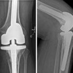 Fig. 2 Radiographs of the left knee at 7 months after the initial visit, presenting substantial lysis along the medial aspect of the tibia: (left) anteroposterior view, and (right) lateral view.
